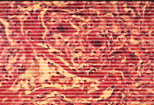 [IMAGE: measles]